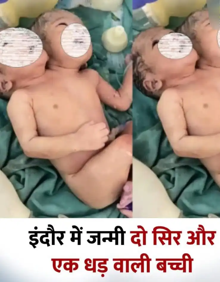 इंदौर में जन्मी 2 सिर और 1 धड़ वाली बच्ची
